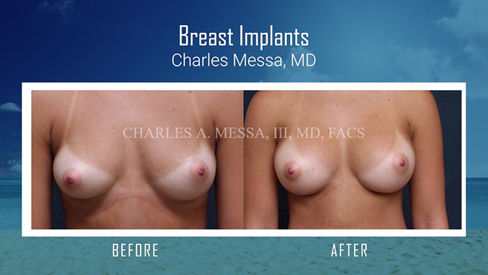 Breast augmentation by Dr. Messa.