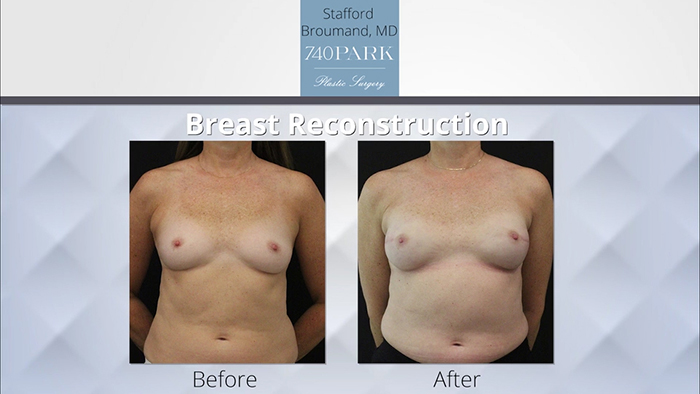 Breast reconstruction results - Broumand.