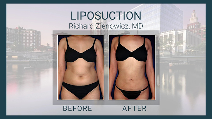 Body contouring results - Dr. Zienowicz.