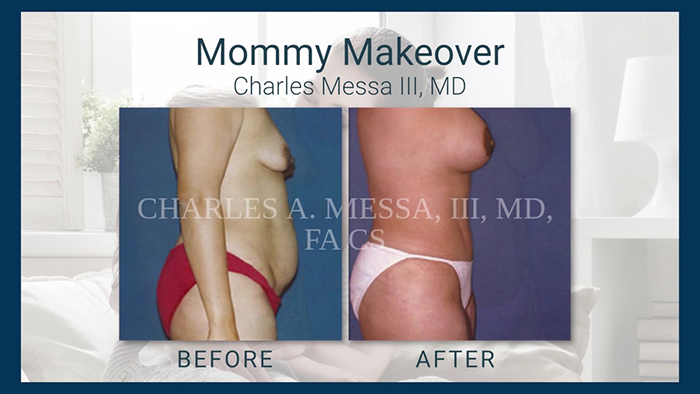 Mommy Makeover Results - Charles Messa.