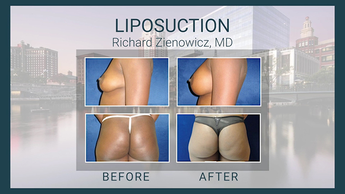 Liposuction patient - Dr. Zienowicz.