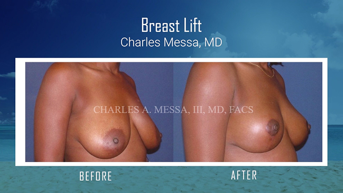 Breast lift by Dr. Messa.