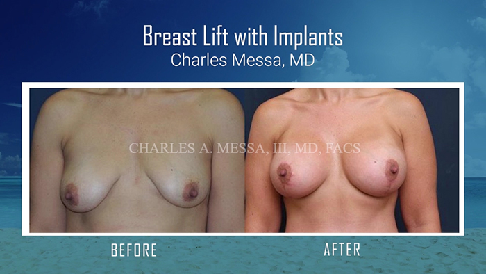 Breast lift with implants - Messa.