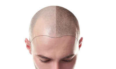 Stem Cells for Male Pattern Baldness.