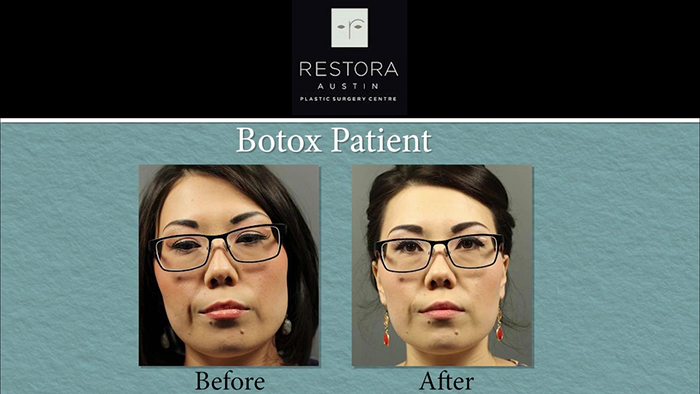 Botox results - Dr. Reid.
