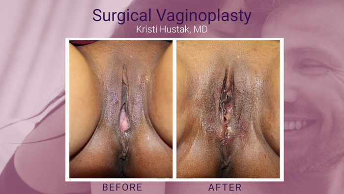 Vaginoplasty results.