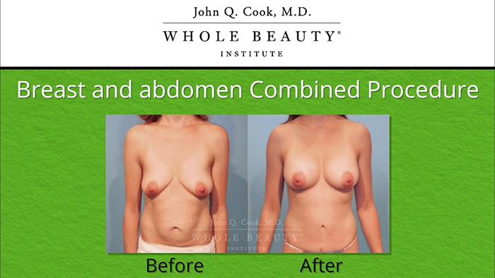 Combined Tummy Tuck and Breast Augmentation for Moms.