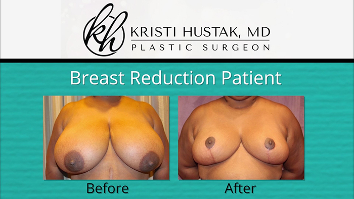 Breast reduction before and after - Dr. Hustak.