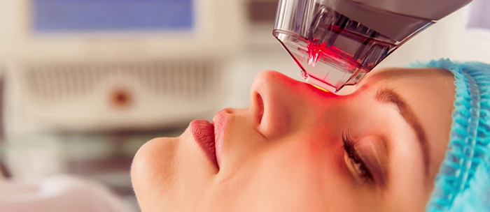 Laser treatments for hyperpigmentation.