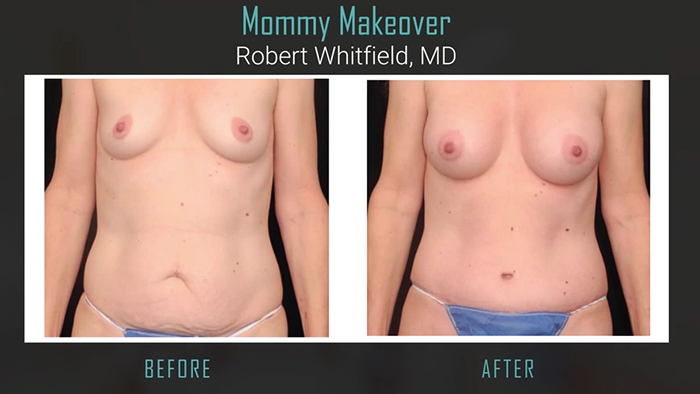 Female rejuvenation - tummy tuck.