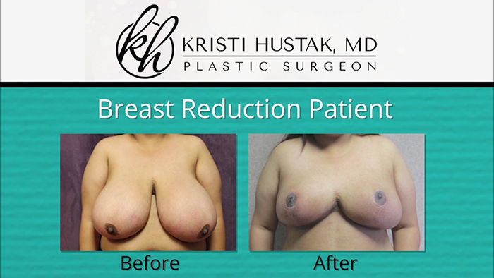 Breast reduction patient - Dr. Hustak.