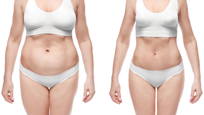 High Def Liposuction - Female.