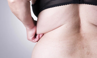 Sagging Skin After Massive Weight Loss Demands Plastic Surgery.