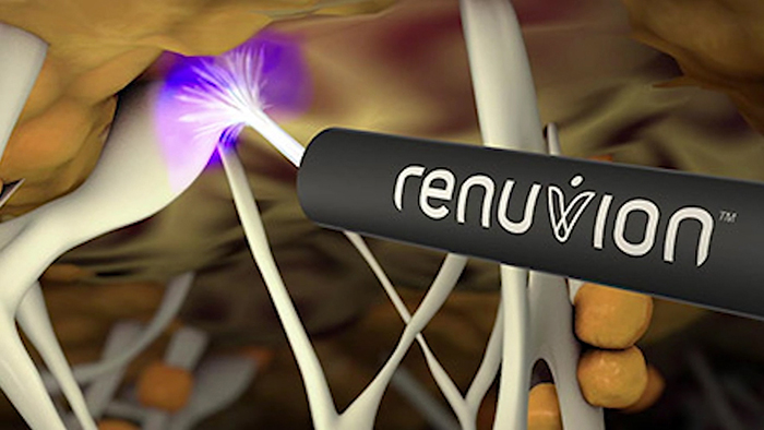 How Renuvion works.