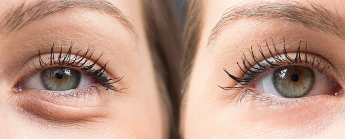 Difference in Lower Eyelid Rejuvenation.