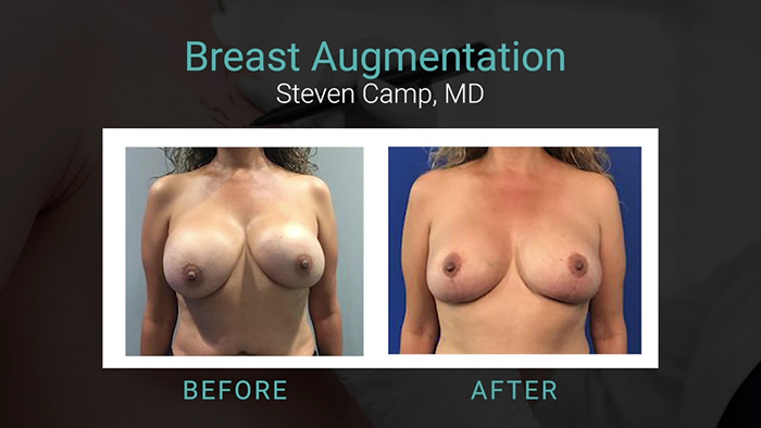 Breast revision with Dr. Camp.