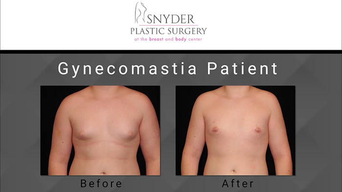 Switching from Gynecomastia to a Flat Chest with Surgery - The Plastic  Surgery Channel