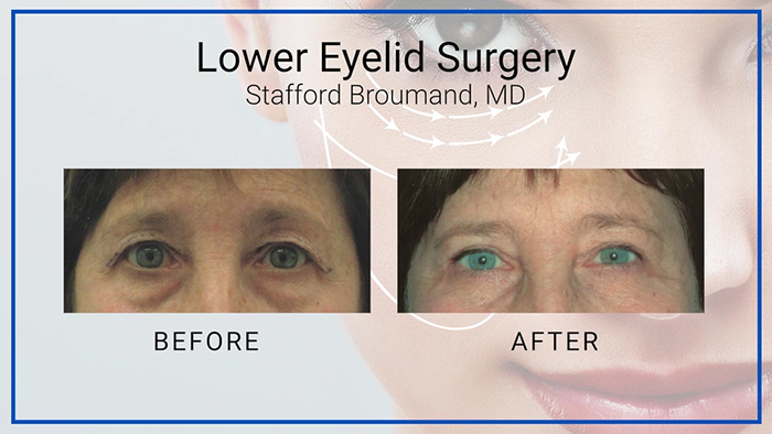 Lower eyelid surgery - Broumand.