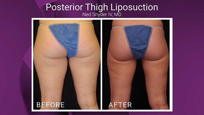 Posterior liposuction - Snyder.