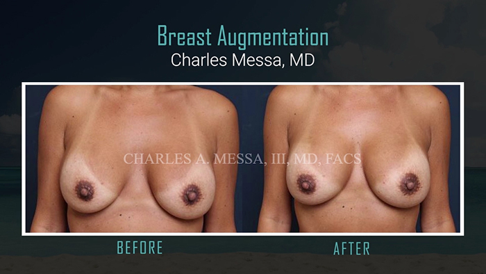 Correcting asymmetric breasts - Messa.
