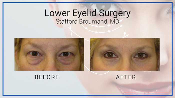 Lower Eyelid Results - Broumand.