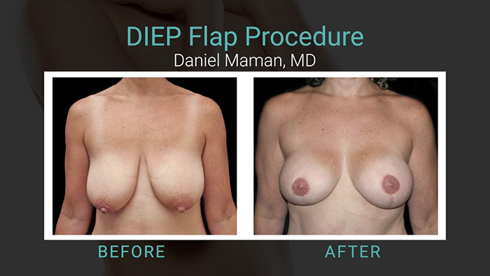 DIEP Flap Results 2 - Maman.