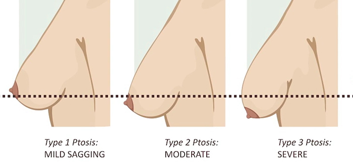 Testing for breast lift.