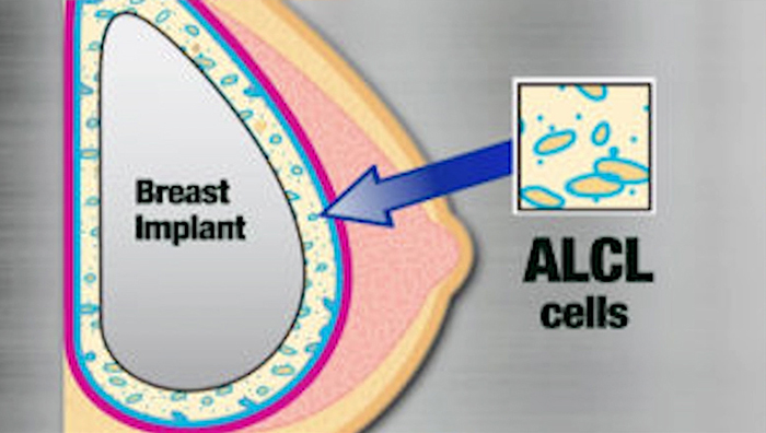 BIA-ALCL - causes.