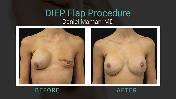 DIEP flap results - Maman.