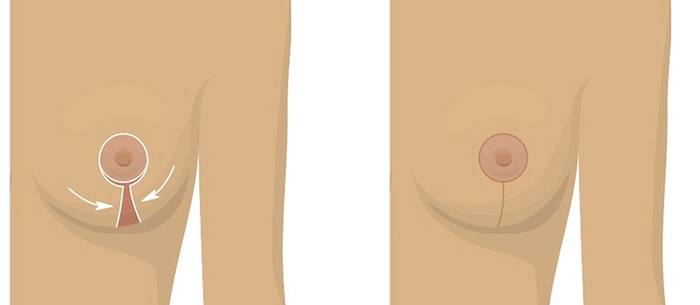 Breast lift incision options.