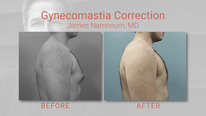 Gynecomastia patient - Dr. Namnoum.