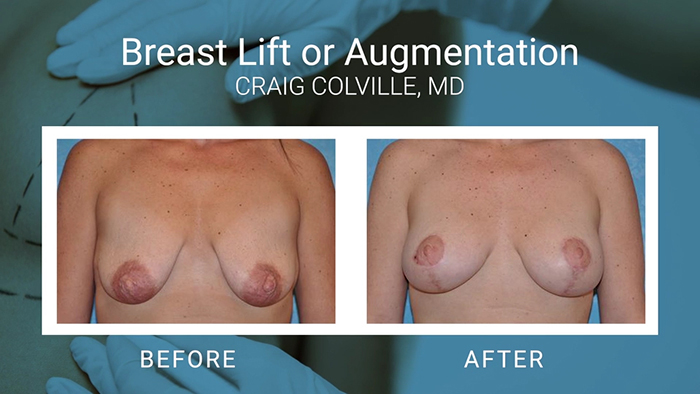 Breast lift with Dr. Colville.