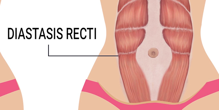 Rectus diastasis diagram.