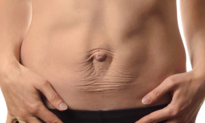 Rectus Diastasis - How To Get Rid of the Abdominal Bulge.