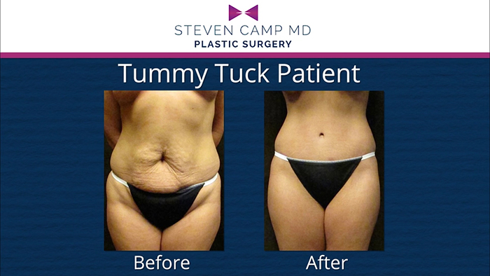 Dr. Camp - tummy tuck patient.