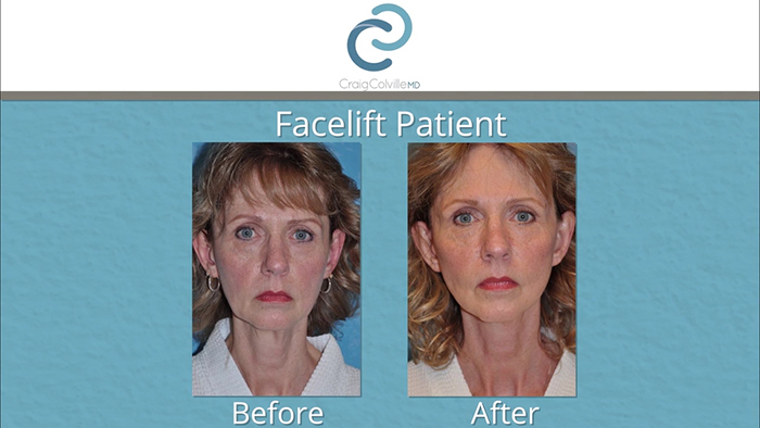 Craig colville facelift results.
