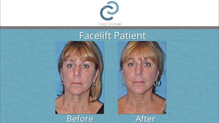 Craig Colville facelifts results #2.