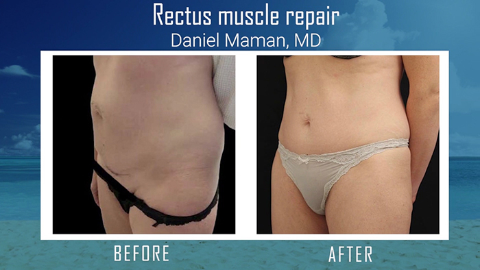 Rectus diastasis repair - Maman.