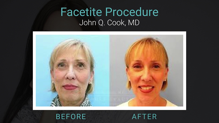 FaceTite Results - Dr. Cook.