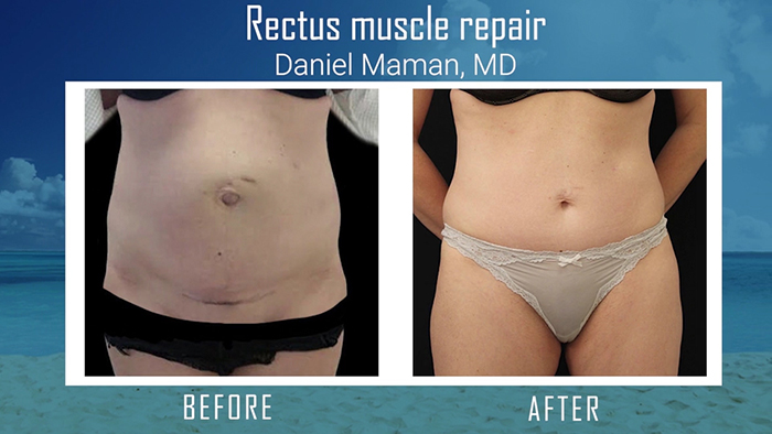 Rectus diastasis results - Maman.