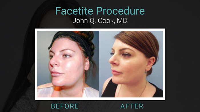 FaceTite patient - Dr. Cook.