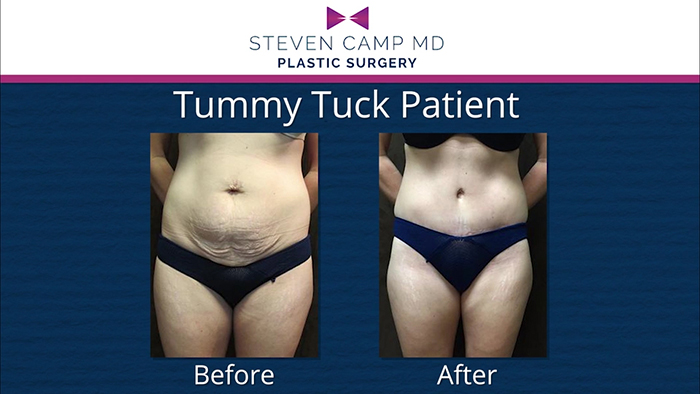 Dr. Steven camp - tummy tuck.