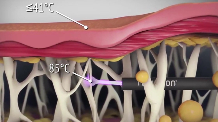 The renuvion procedure.