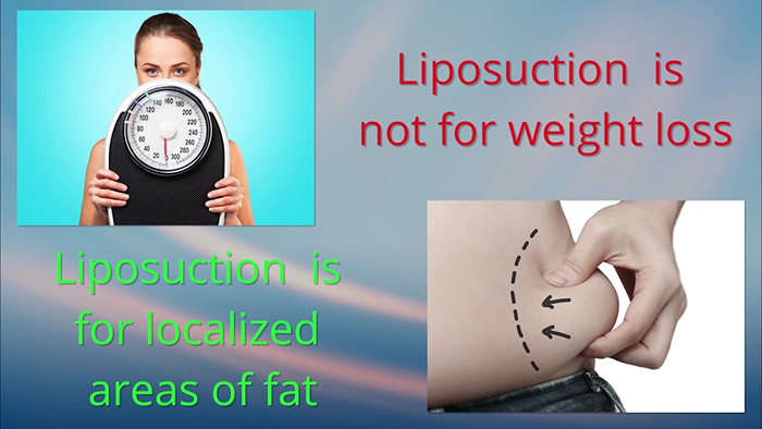 Lipsuction is Not About Weight Loss.