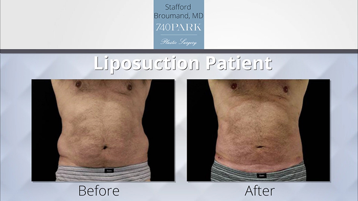 Dr. Broumand Liposuction Patient.