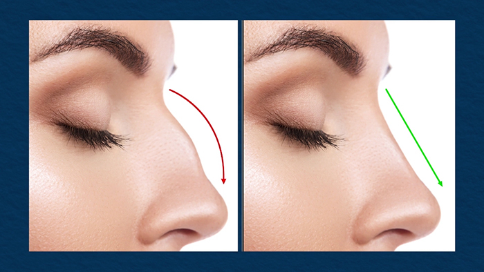 Non-surgical rhinoplasty.