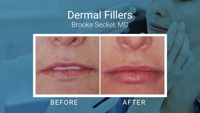 Dermal filler results - Seckel.