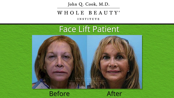 Facelift results - John Q. Cook.