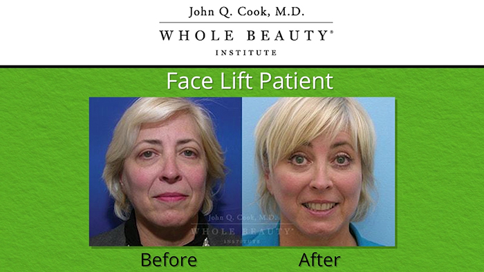 Facelift results - Dr. Cook.