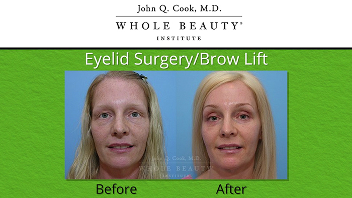 Eyelid browlift results - Dr. Cook.